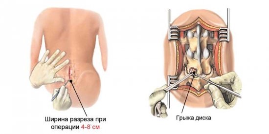 Микрохирургия грыжи