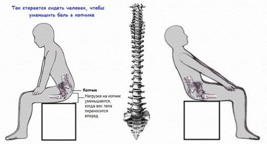 Боль в копчике