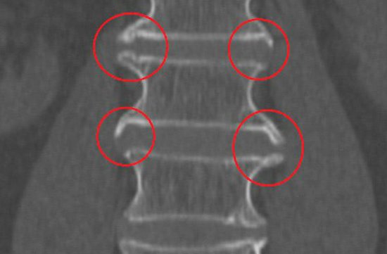 Краевые остеофиты на рентгене