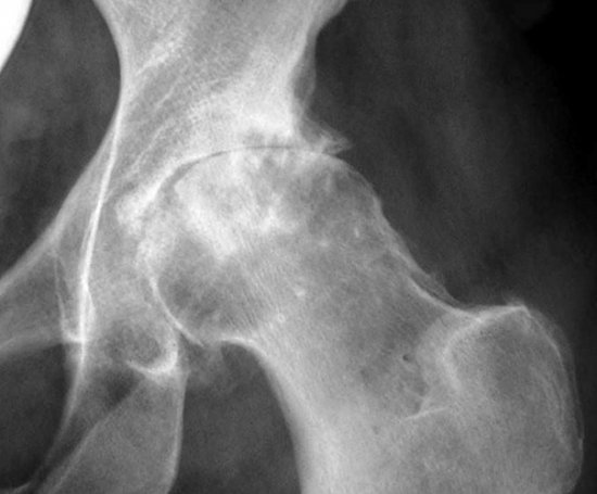 Рентген тазобедренного сустава