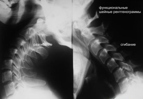 Рентгенография шейного отдела позвоночника