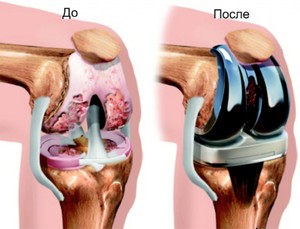 Эндопротезирование колена