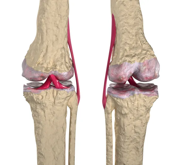 Osteoarthritis : Knee joint with ligaments and cartilages Stock Picture