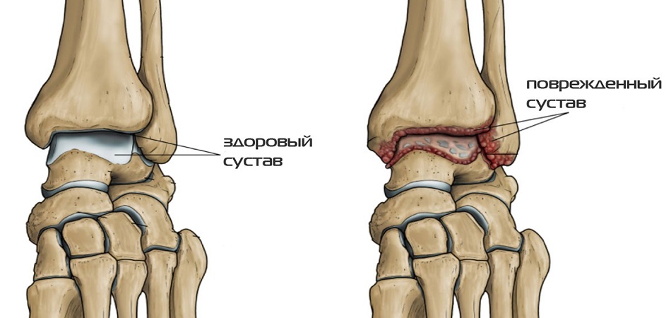 Артроз голеностопного сустава