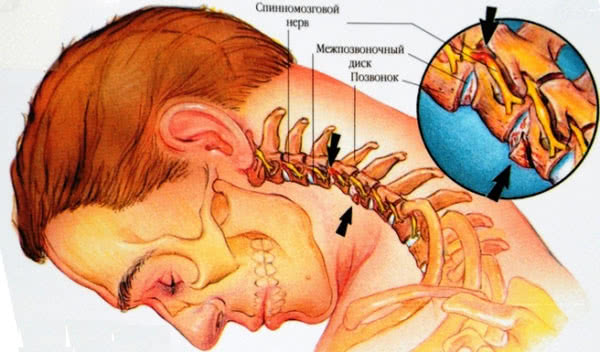 Что такое остеохондроз шейного отдела
