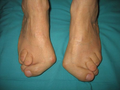 Деформация пальцев на ногах