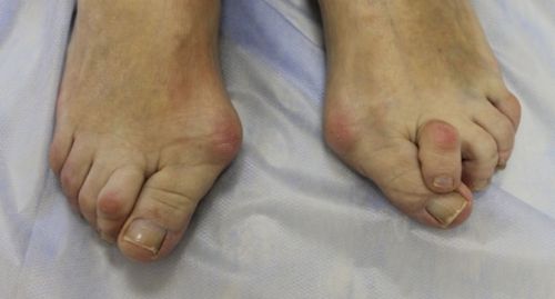 Деформированные пальцы ног