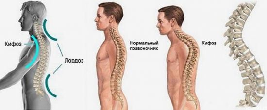 Кифоз и лордоз позвоночника