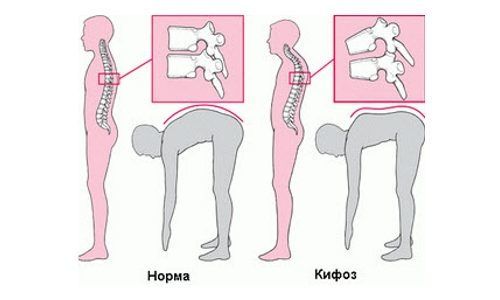 Тест на наличие кифоза