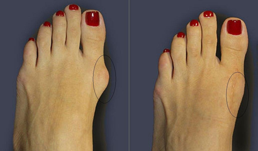 Косточка на большом пальце ноги - лечение в домашних условиях