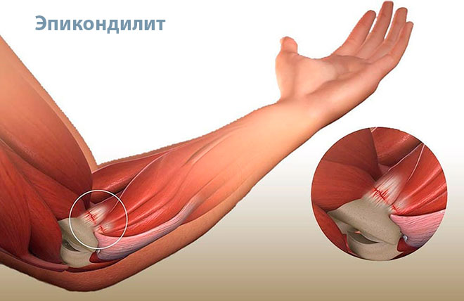 Воспаление сухожилий мышц вокруг локтя вызывает тендинит (другое название – эпикондилит). Он может быть наружным и внутренним