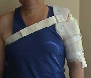 Фиксирующий бандаж на плечевой сустав в каких случаях необходим