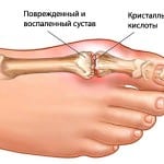 развитие шпоры на пальце ноги