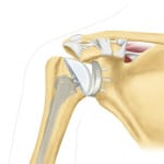 Тотальное эндопротезирование плечевого сустава
