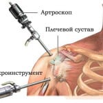 артроскопия плечевого сустава