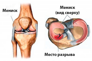 Не хрустиМенископатия коленного сустава симптомы