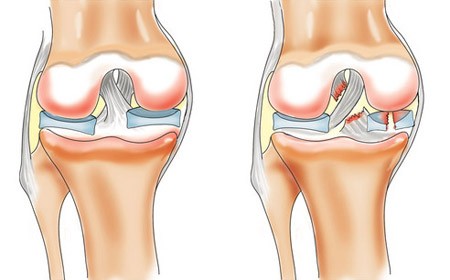 Не хрустиМенископатия коленного сустава симптомы