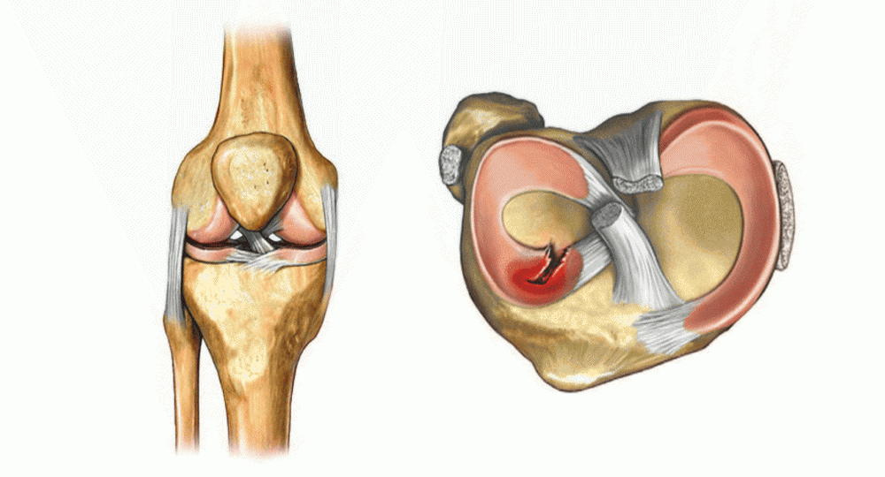 Повреждение мениска коленного сустава код по МКБ-10