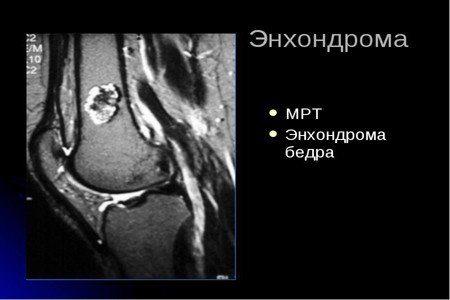 Энхондрома бедренной кости симптомы, лечение и прогноз