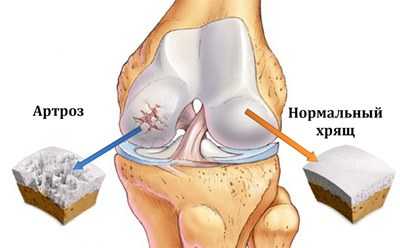 Капустный лист при артрозе коленного сустава