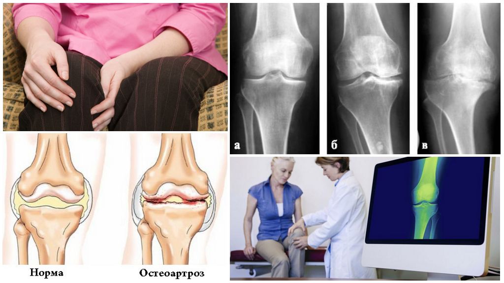 Остеоартроз это. Деформирующий артроз (остеоартроз). Деформирующий остеоартроз суставов. Остеоартроз коленного сустава деформация. Деформирующий гонартроз 1.