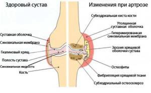 Коксартроз коленного сустава