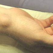 Гигрома у ребенка на руке: лечение и фото запястья у детей