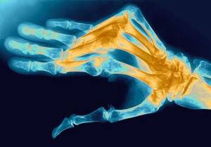 артрит пальцев рук