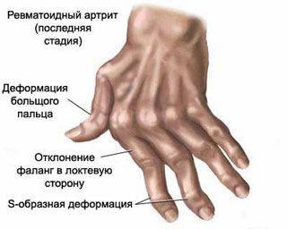 Деформация пальцев при артрите