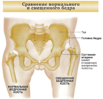 Артроскопия тазобедренного сустава