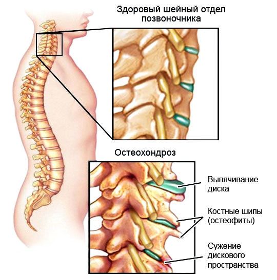 Остеохондроз позвоночника