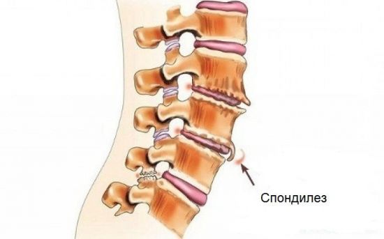 Спондилез позвоночника