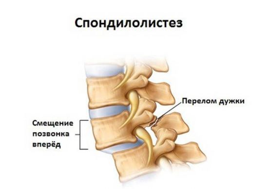 Спондилолистез