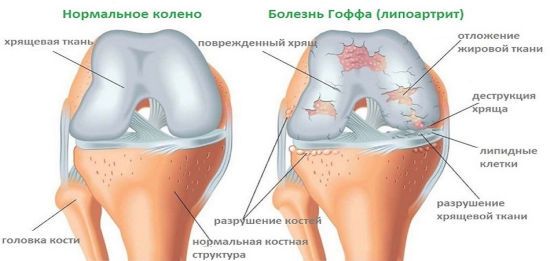 Жировая ткань на коленном суставе