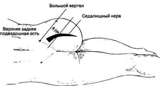 Боковой доступ для блокады