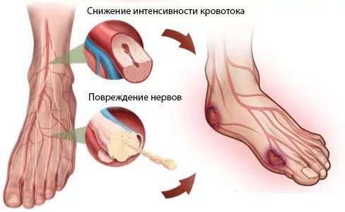 Кровообращение в ногах при диабете