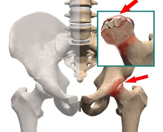 пораженный тазобедренный сустав