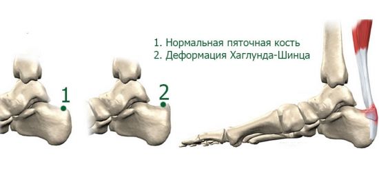 Деформация пяточной кости