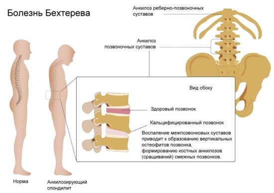 Информация о болезни Бехтерева