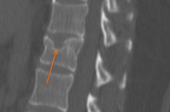 Рентген-снимок позоночника с грыжей