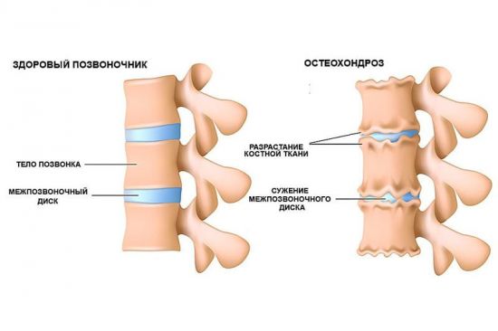 Остеохондроз