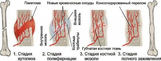 Образование костной мозоли