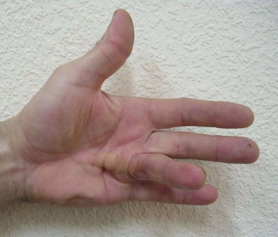 Кривые пальцы