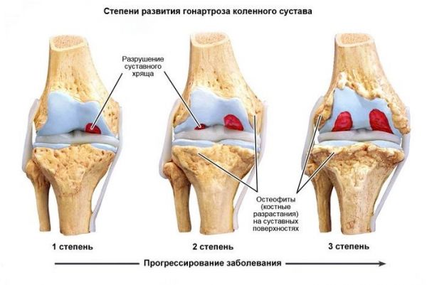 Артроз коленного сустава