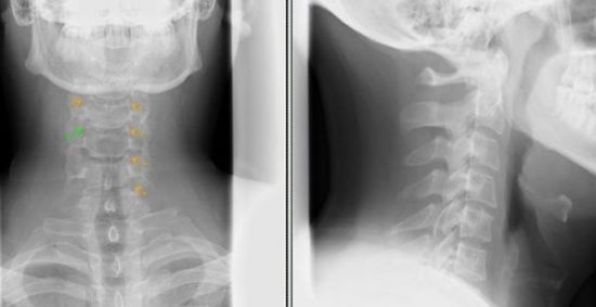 Рентген-снимок шейных позвонков