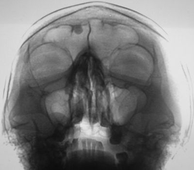 Рентген-снимок лобных пазух