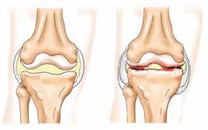 Схема воспаления коленного сустава