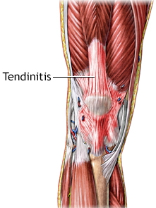 Тенденит коленного сустава