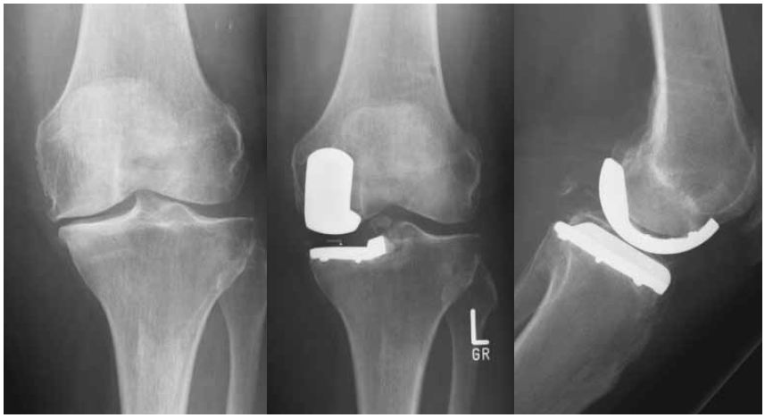 Протез колена на рентгеновском фото