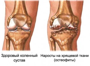 Как проявляются остеофиты коленного сустава